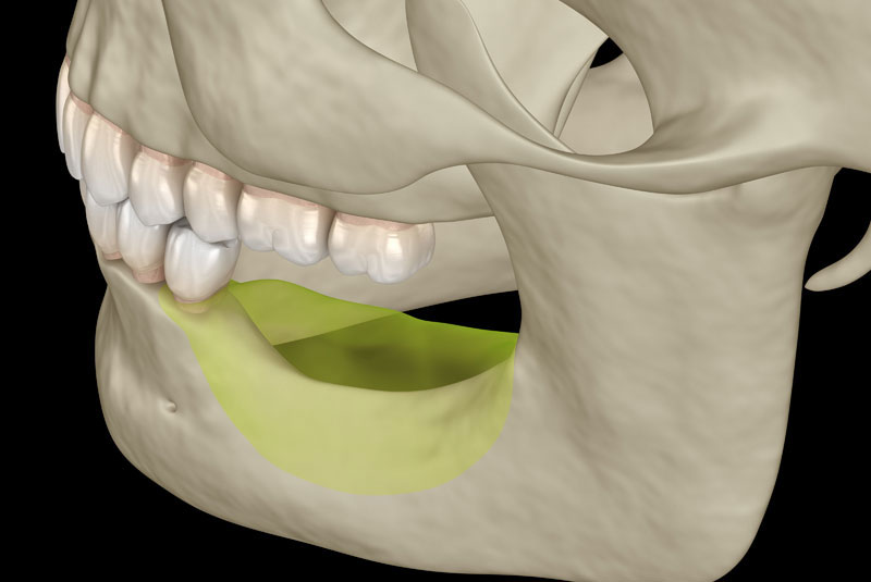 jaw bone loss graphic