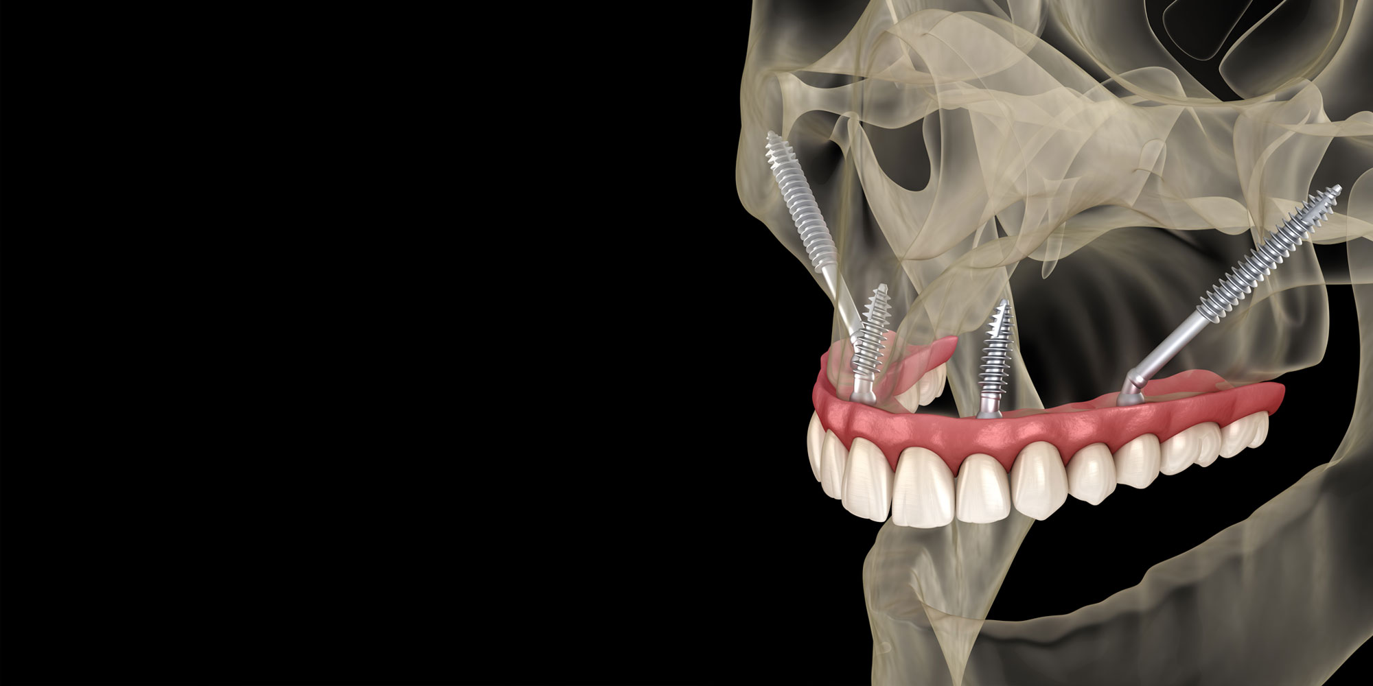 zygomatic implant model mchenry