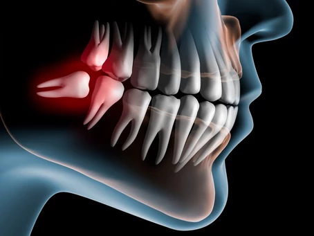 Oral Surgeon in Bozeman, Montana: Wisdom Teeth