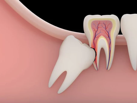 WISDOM TOOTH REMOVAL