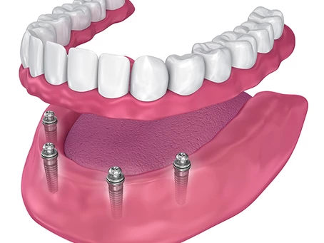 THE FULL GUIDE TO DENTAL IMPLANTS