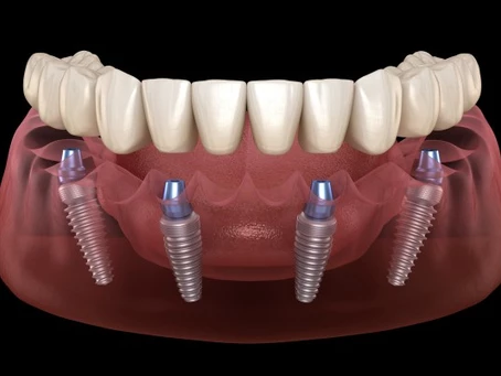7 REASONS WHY YOU SHOULD REPLACE MISSING TEETH WITH DENTAL IMPLANTS