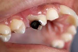 Dental Cavities