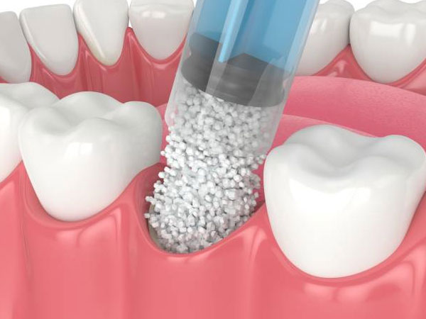 The Role of Bone Grafting in Dental Implant Surgery