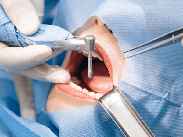 The Process of Getting Dental Implants: What to Expect