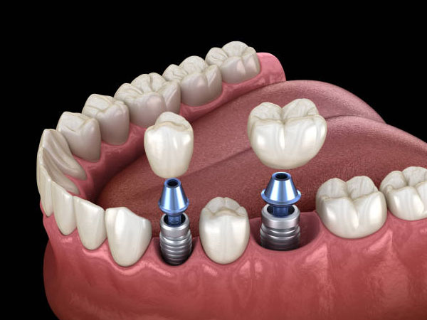 Dental Implants for Different Age Groups: Considerations and Benefits